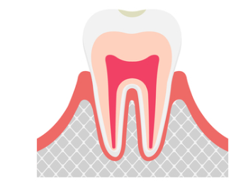 C0【ごく初期の虫歯】
