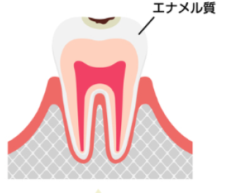 C1【エナメル質の虫歯】