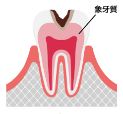 C2【象牙質の虫歯】