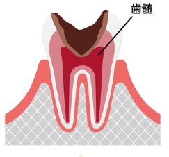 C3【神経まで達した虫歯】