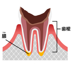 C4【歯根まで達した虫歯】
